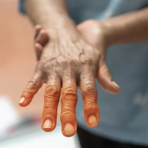 Older hands with arthritis pain