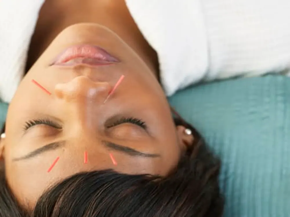 Acupuncture at HealthSource of Harvest in Harvest