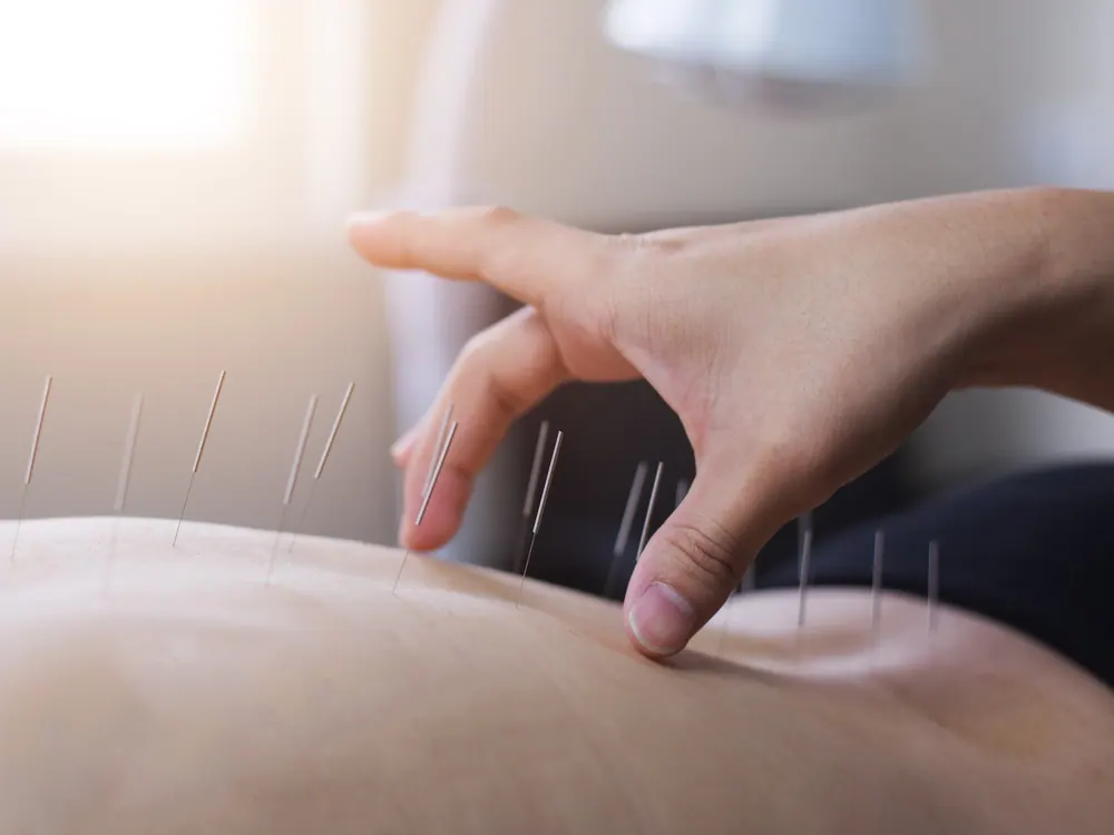 Acupuncture at HealthSource of Harvest in Harvest