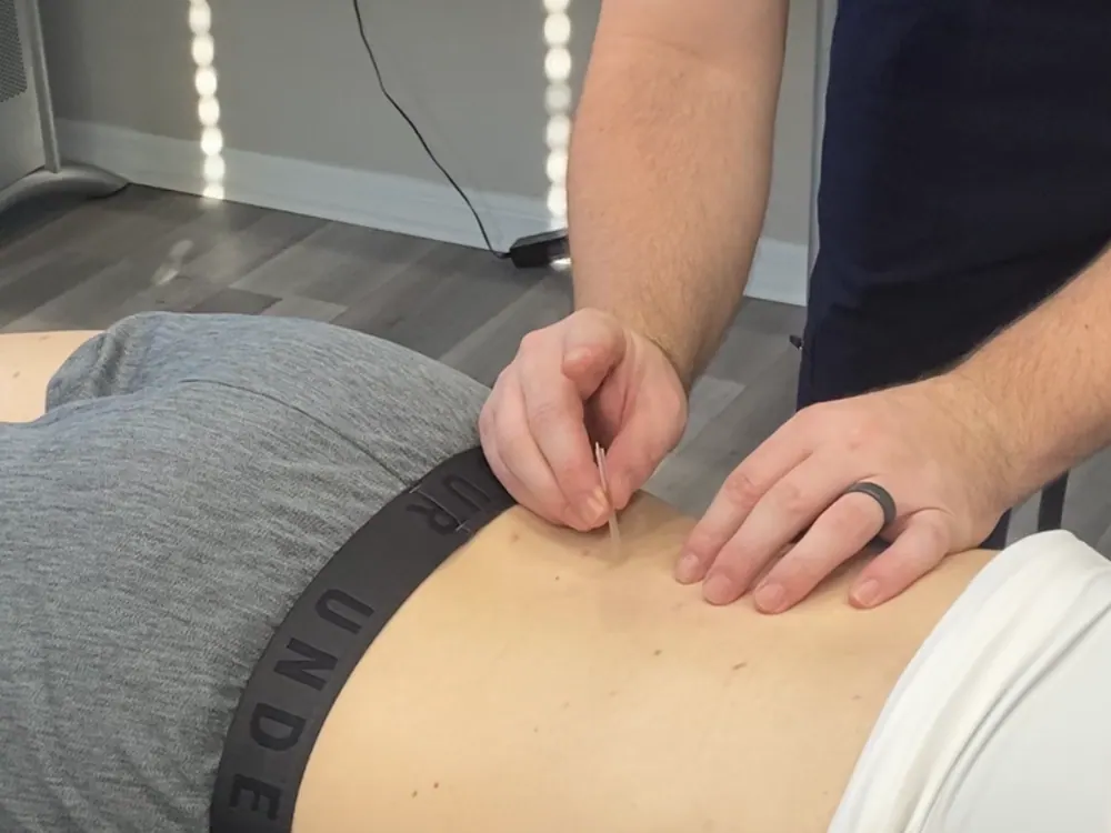 How Acupuncture works at HealthSource of Harvest