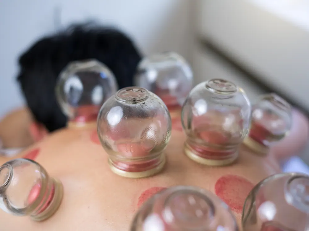 Cupping Therapy at HealthSource of Harvest in Harvest