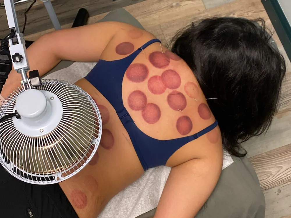 How Cupping Therapy works at HealthSource of Harvest