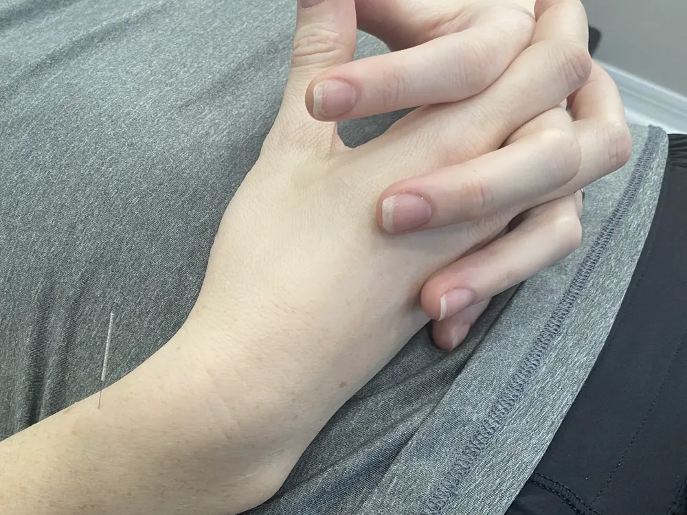 Dry Needling at HealthSource of Harvest in Harvest