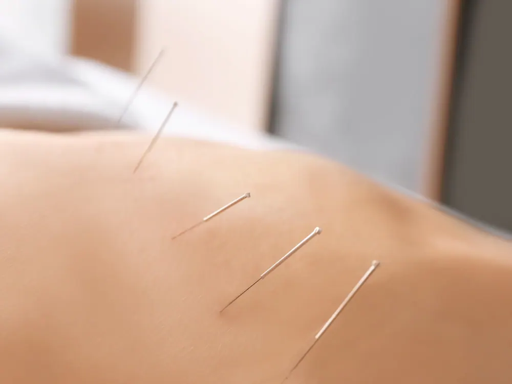 Dry Needling at HealthSource of Harvest in Harvest