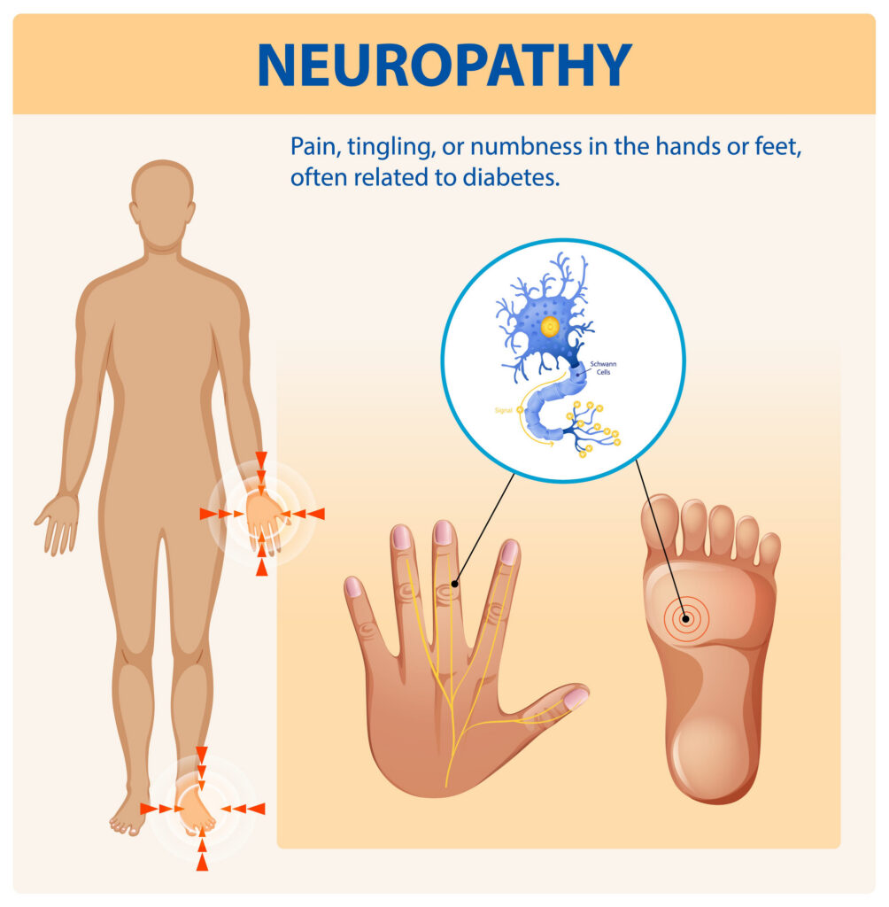 Neuropathy Education